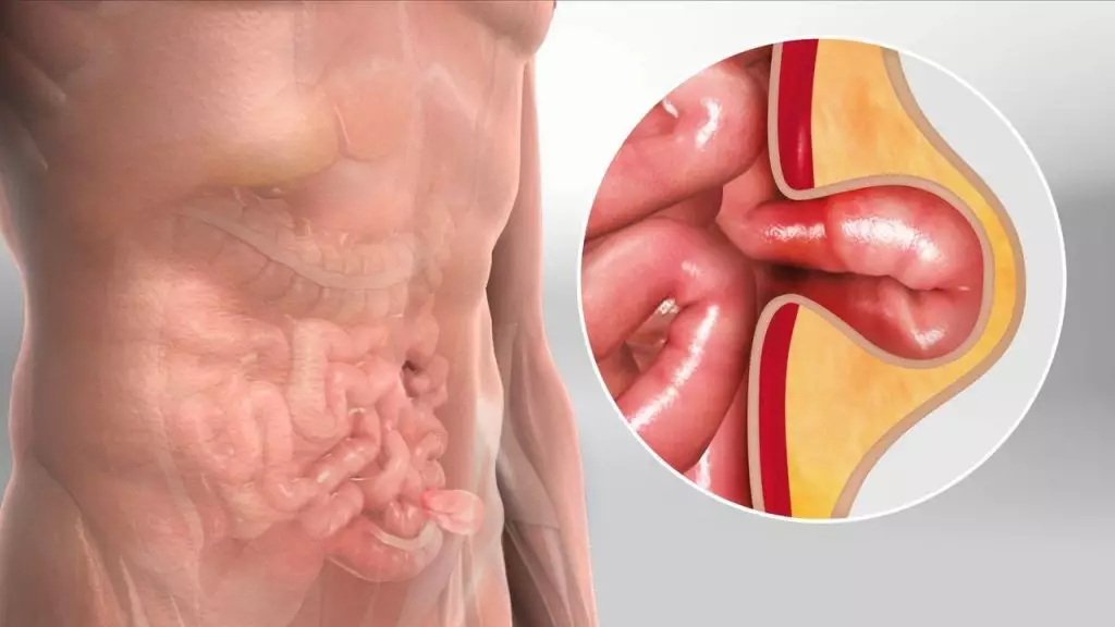 Representative photo showing the inside of an abdominal hernia