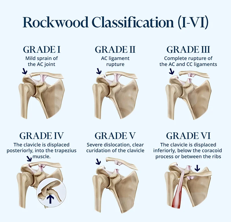 The picture shows the degrees of damage to the acromioclavicular joint from 1 to 6