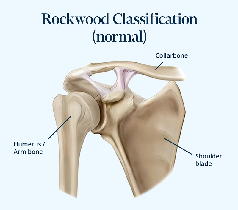 The picture shows the clavicle and where the pain is located for acromioclavicular dislocation