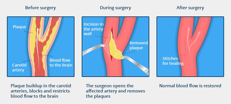 The picture shows the surgical process for carotid endarterectomy, before surgery, during surgery, and after surgery