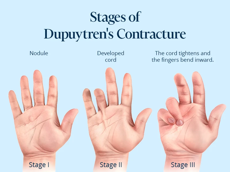 The picture shows the stages of Dupuytren's contracture. Dupuytren's disease pictures