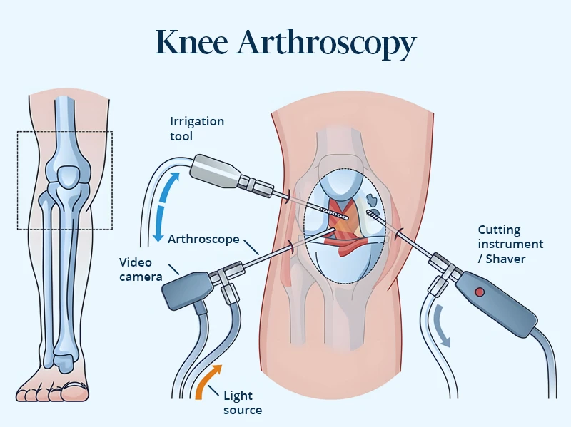Detailed drawing showing the revolutionary and minimally invasive technique: knee arthroscopy