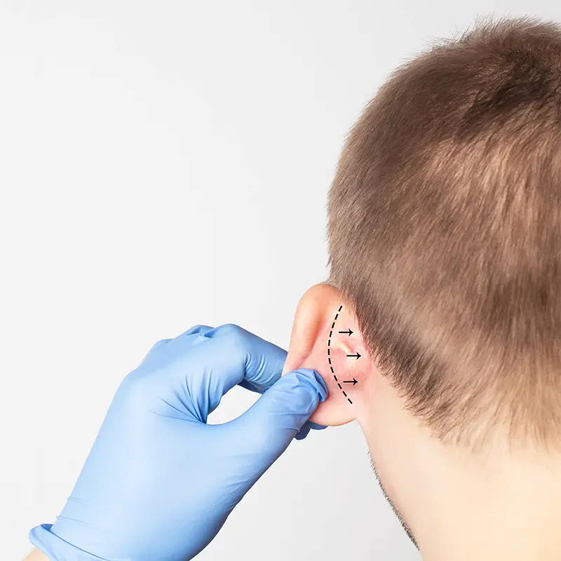 Representative photo showing the effect of otoplasty surgery.