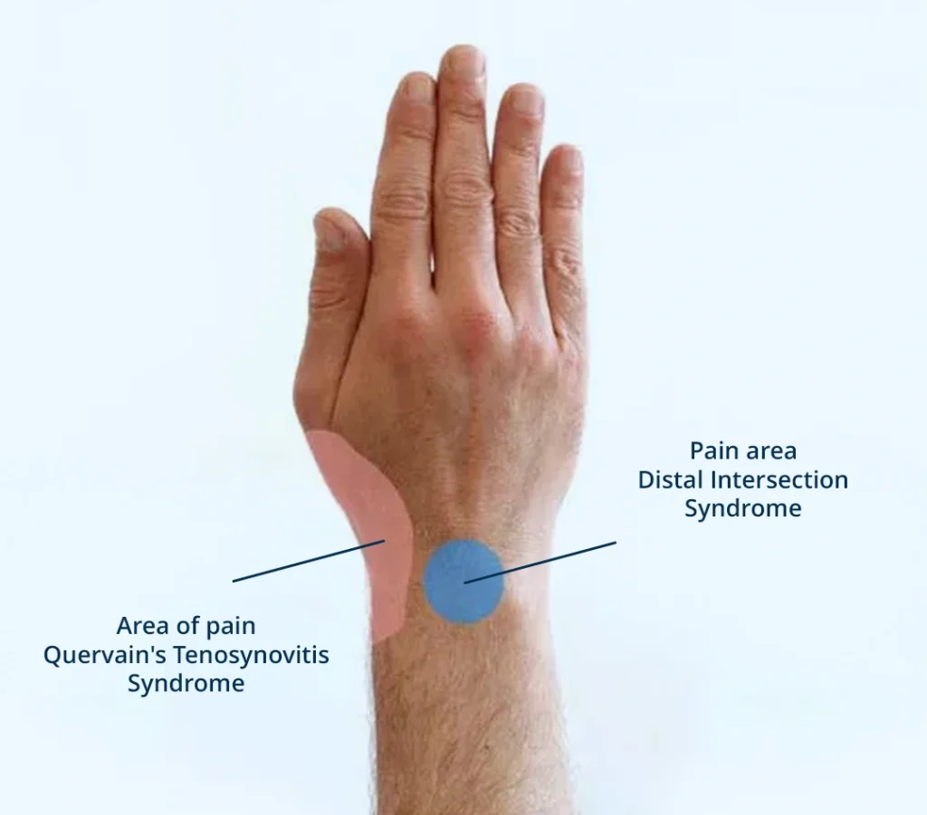 Representative image showing pain radiating to the thumb due to Quervain's tenosynovitis