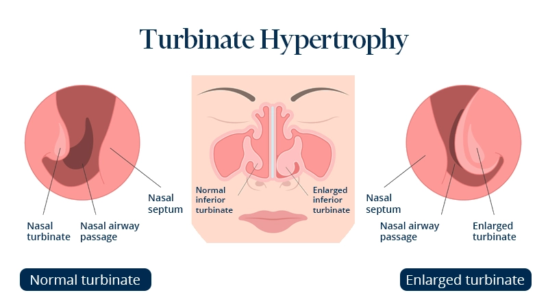 The picture shows how the radiofrequency turbinoreduction procedure is performed.