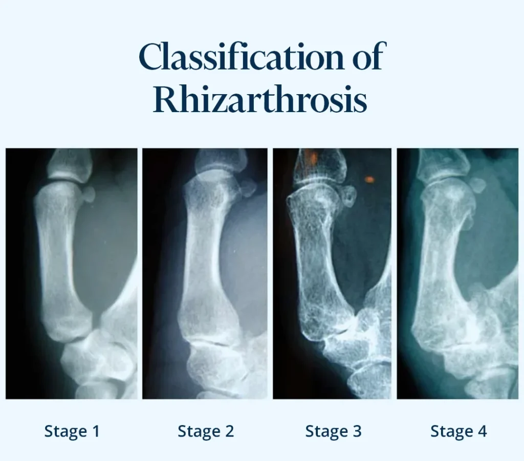 Representative image showing the stages of rhizarthrosis