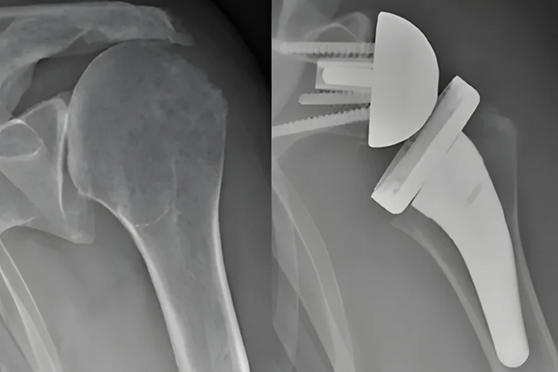 The photo shows a shoulder before and after shoulder replacement surgery.