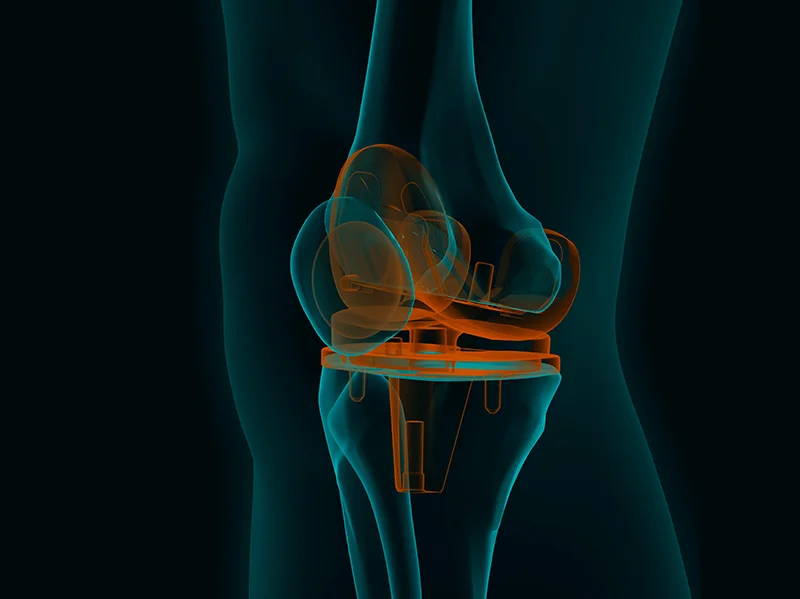 The image shows a 3D rendering of the total knee prosthesis in place.