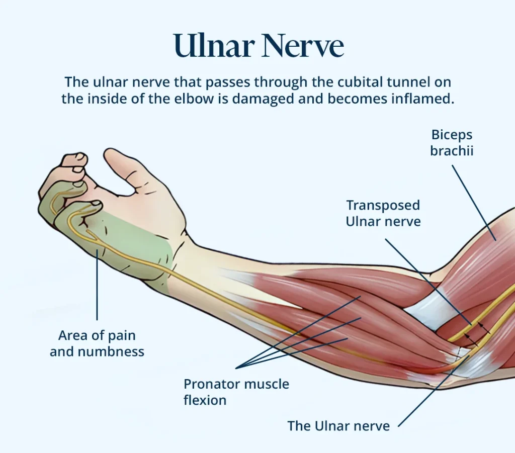 Representative picture: the ulnar nerve that passes through the cubital tunnel on the inside is damaged and inflamed