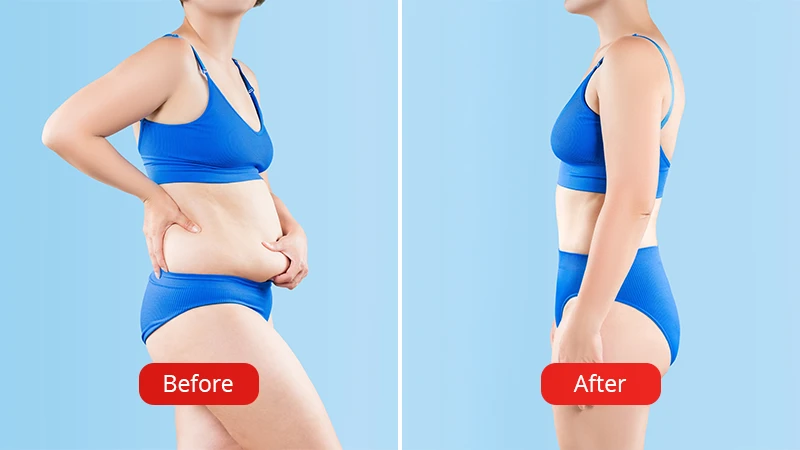 Before and after liposuction procedure in Cluj
