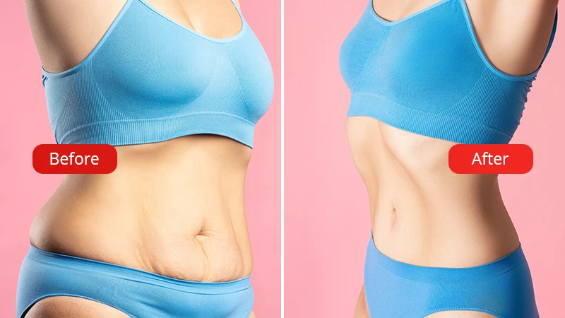Before and after Tummy Tuck or Abdominoplasty procedure at VenArt Clinic