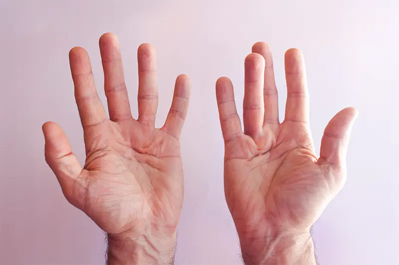 Representative image of Dupuytren's contracture, showing how this hand condition appears