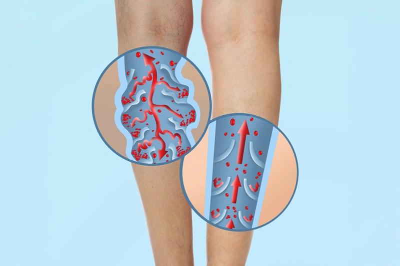 Representative image of varicose vein removal by stripping