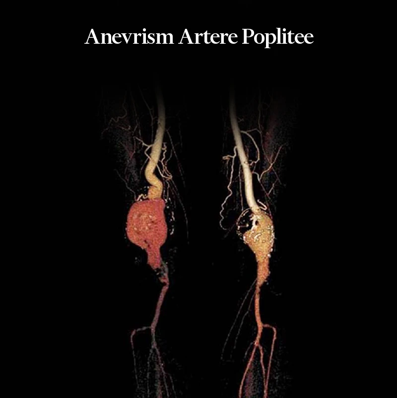 Poza detaliata cum arata un anevrism de artera poplitee