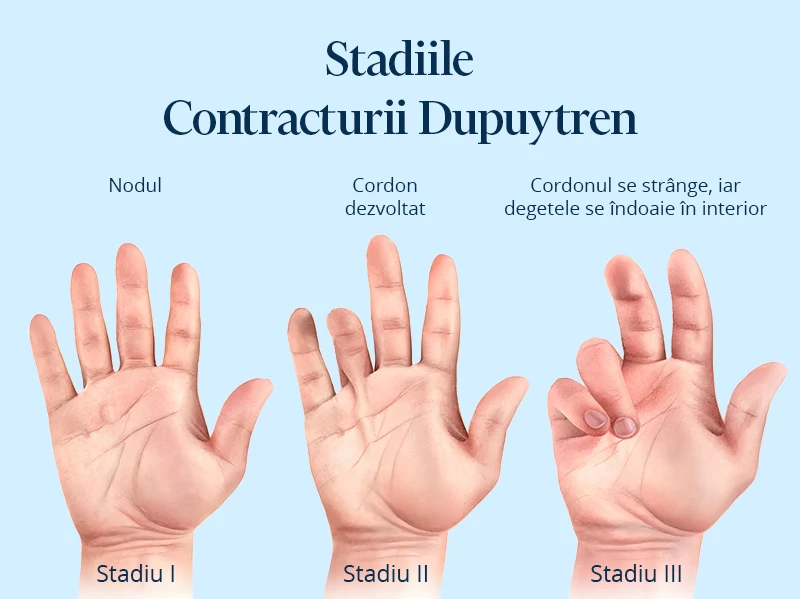 Poza afiseaza stadiile pentru contractura Dupuytren. boala dupuytren poze