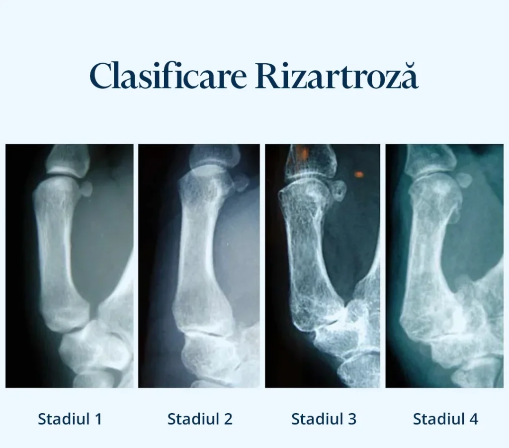 Poza reprezentativa cu stadiile afectiunii de rizartroză