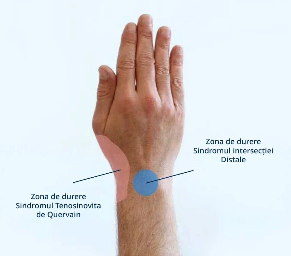 Poza reprezentativa cu durerea care radiaza la degetul mare pentru afectiunea tenosinovita de quervain