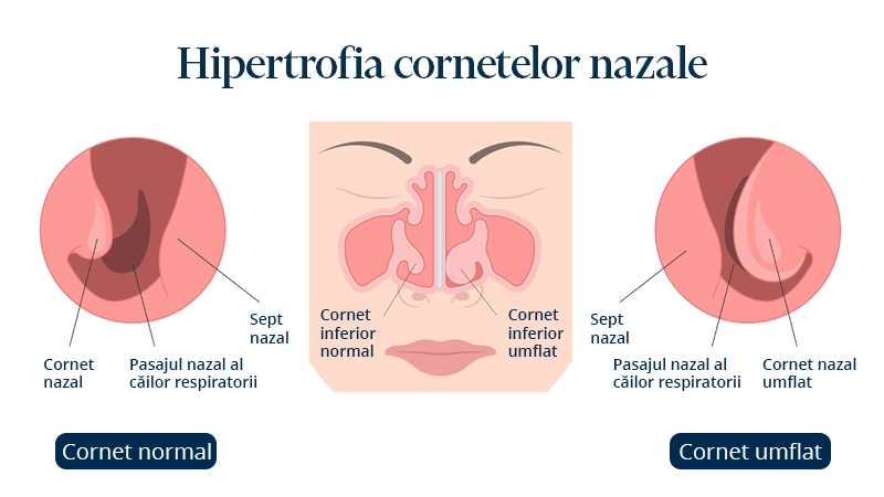 Poza reprezinta cum se desfasoara procedura de Turbinoreductie cu radiofrecventa.
