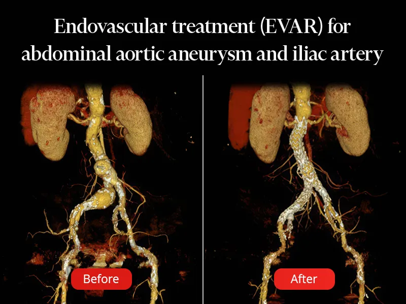 Detailed image showing an abdominal aortic aneurysm before and after treatment