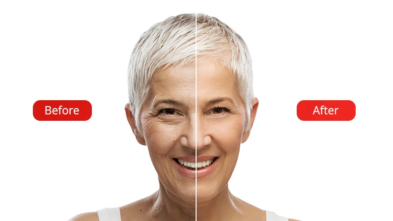 The photo shows the results before and after the botulinum toxin Botox procedure at the Venart clinic.