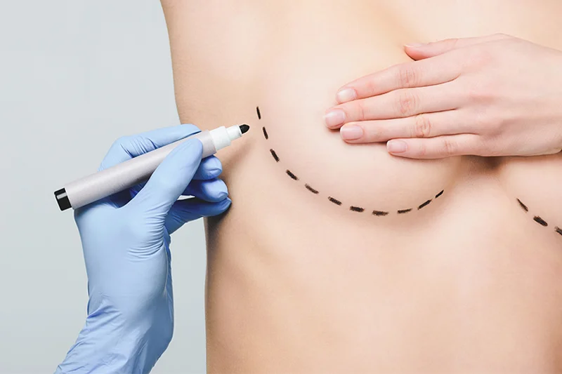 Representative photo for the Breast Reconstruction procedure at VenArt Clinic