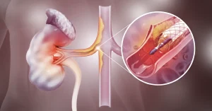 Representative photo for the article "Angioplasty and renal artery stenting: minimally invasive treatment for renal artery stenosis" by the VenArt clinic