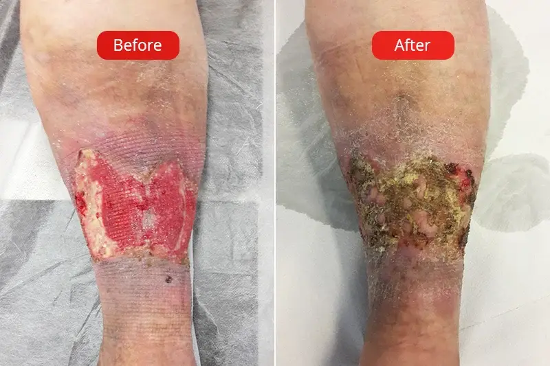 Before and after photos of varicose ulcers at the VenArt clinic