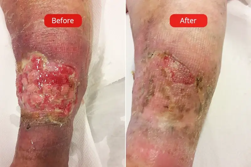 Before and after photos of varicose ulcers at the VenArt clinic