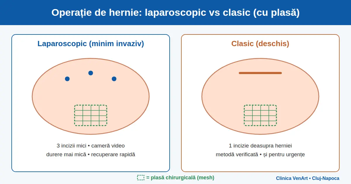operație de hernie laparoscopic vs clasic – diagramă comparativă