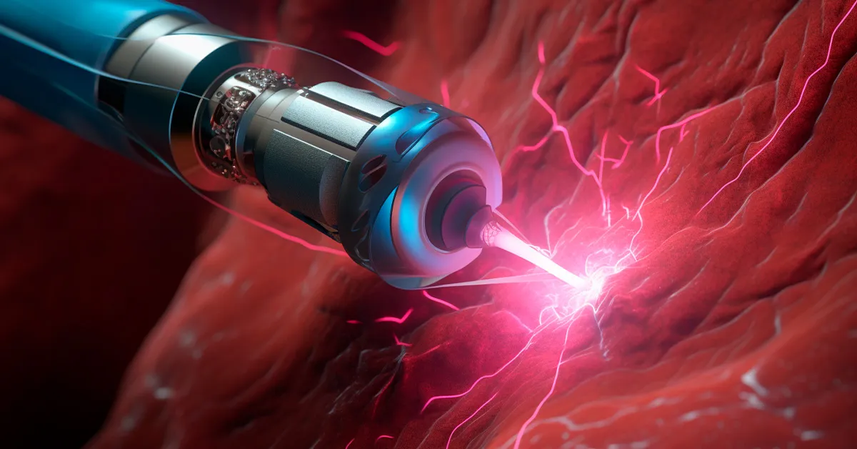 Hemoroizi: tratament cu laser (minim invaziv) 1 Tratamentul hemoroizilor cu laser - procedură minim invazivă
