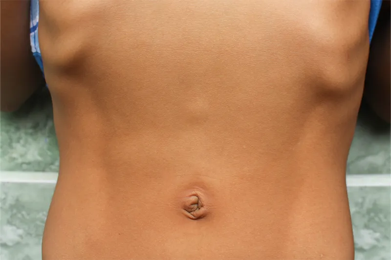 Hernia epigastrică (hernia liniei albe): simptome, operație și preț. Torsul unui bărbat surprins din lateral, zona abdominală superioară