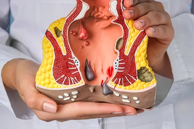Medic prezentând un model anatomic al regiunii anorectale cu hemoroizi și tromboză hemoroidală