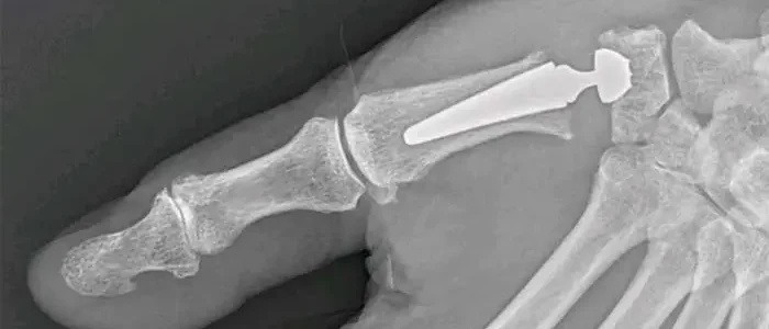 The photo shows rhizarthrosis after surgery